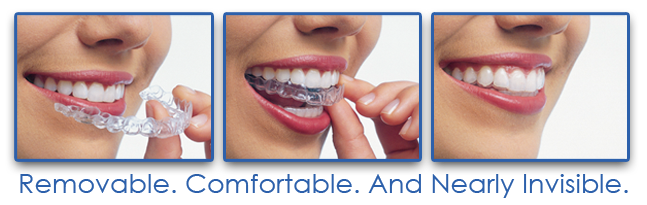 Invisalign Edmonton