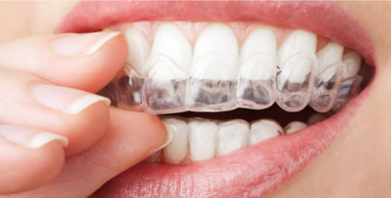 Invisalign Edmonton