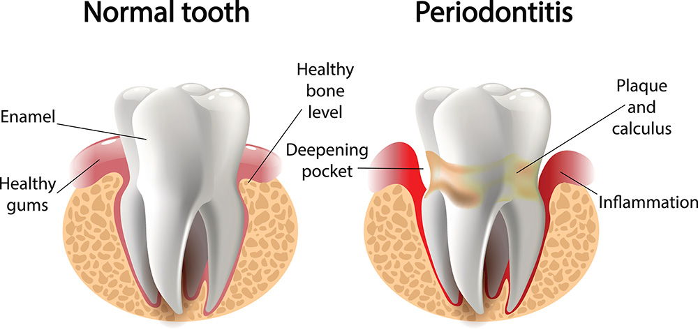 Invisalign